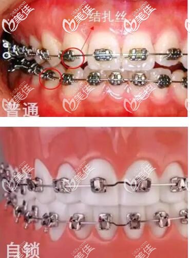 自锁托槽和非自锁区别 自锁托槽和非自锁区别