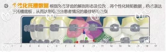 insignia精准正畸个性化托槽 insignia精准正畸个性化托槽