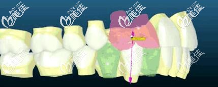insignia精准正畸3d可视化 insignia精准正畸3d可视化