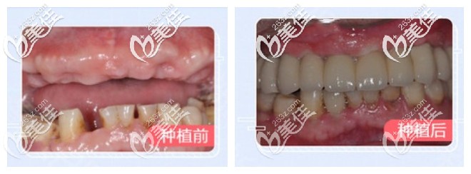 半口种植牙前后对比照 半口种植牙前后对比照