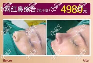 海南华美网红鼻综合真人案例图 海南华美网红鼻综合真人案例图