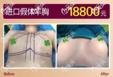 海南华美进口假体丰胸真人前后对比效果图 海南华美进口假体丰胸真人前后对比效果图