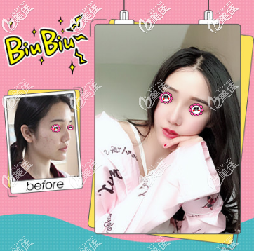 北京壹加壹张绿峰医生鼻综合隆鼻案例 北京壹加壹张绿峰医生鼻综合隆鼻案例