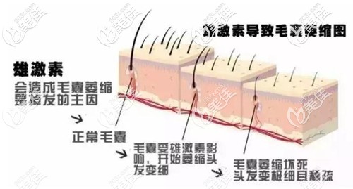 导致雄性脱发的主要原因 导致雄性脱发的主要原因