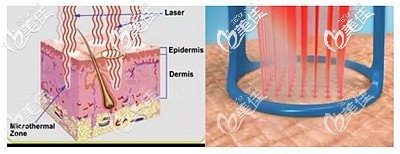 点阵激光祛疤的原理