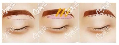 提眉手术的切口位置