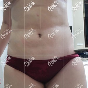 吸脂瘦腰腹术后25天效果