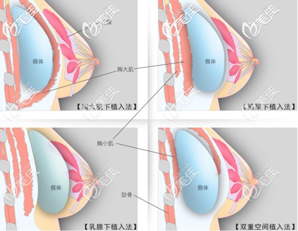 隆胸假体放置的层次 隆胸假体放置的层次