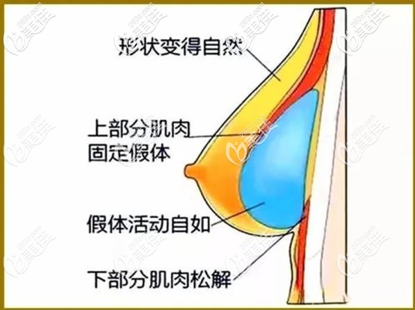 双平面隆胸优势 双平面隆胸优势