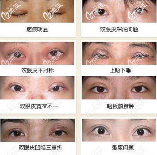 双眼皮失败的八种图片