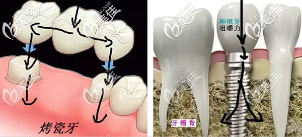 烤瓷牙和种植牙的受力图