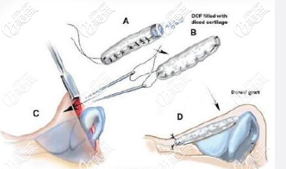 土耳其软糖隆鼻手术原理
