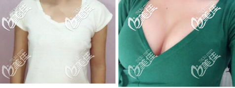 假体隆胸250高凸效果前后对比 假体隆胸250高凸效果前后对比