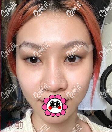 做全切双眼皮前 做全切双眼皮前