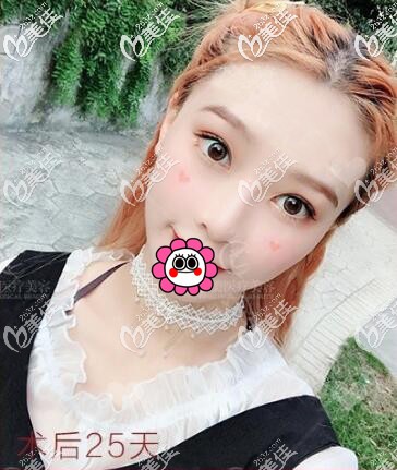 双眼皮术后25天效果 双眼皮术后25天效果