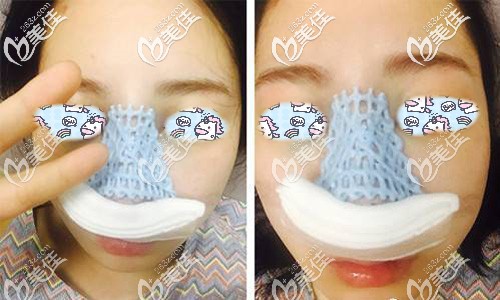 做完自体软骨隆鼻手术后即刻