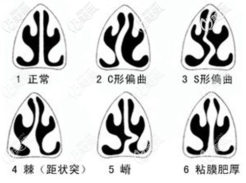医生给出常见的几种鼻中隔偏曲类型