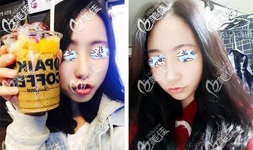 自体软骨隆鼻术后30天肿胀渐消