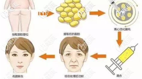 郭帅医生做自体脂肪移植面部手术 郭帅医生做自体脂肪移植面部手术