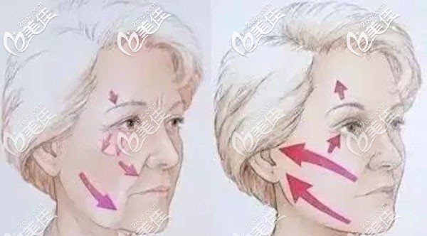 吕佳忆医生在埋线提升方面的5大技术优势