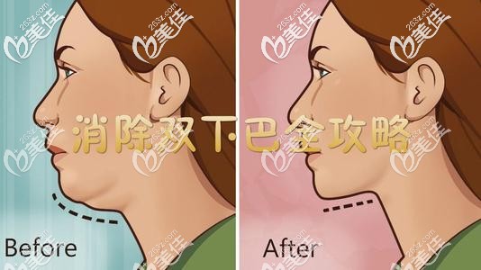 下颌骨发育不足有双下巴