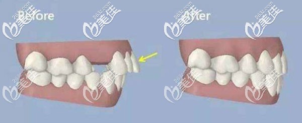 南宁爱思特整形牙齿矫正示意图