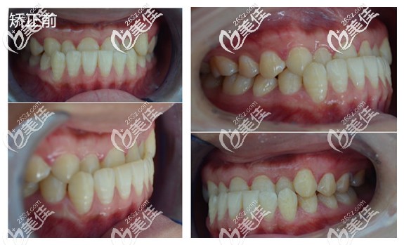 反颌矫正前的照片 反颌矫正前的照片