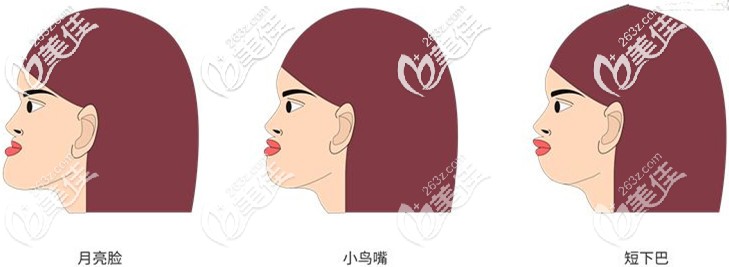 地包天又称为月亮脸 地包天又称为月亮脸