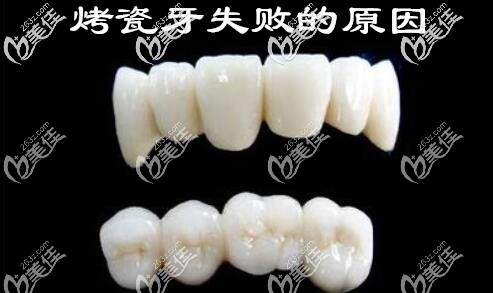 潍坊郑氏口腔刘宝森讲解烤瓷牙修复失败的原因