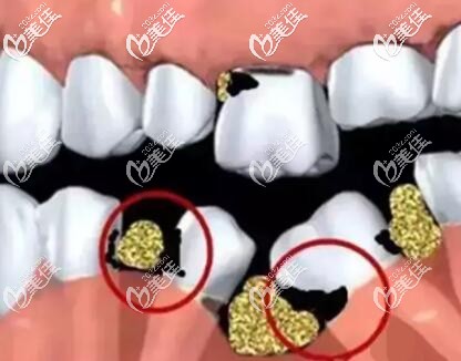 缺牙不种牙的危害