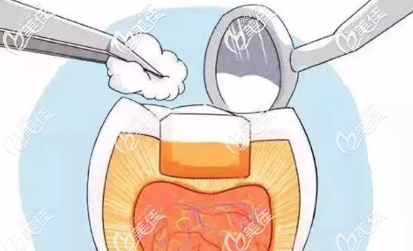 门牙用复合树脂美学修复