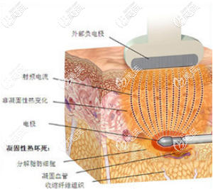 宝丽太吸脂原理示意图