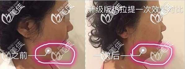 下颌缘做过一次热拉提plus的效果