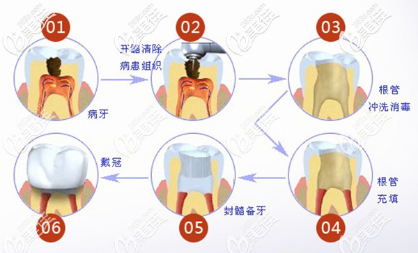 根管治疗过程图解