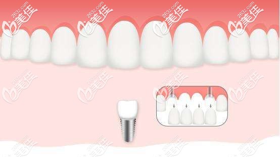 缺4颗牙种两颗种植牙图片