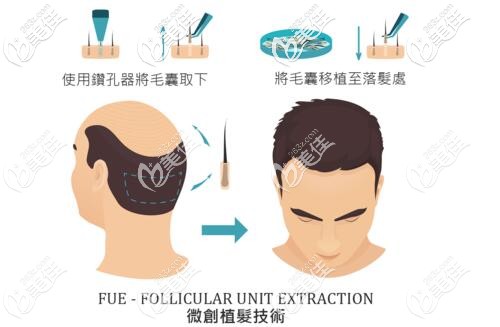 晏医生做微创植发技术的手术示意图 晏医生做微创植发技术的手术示意图