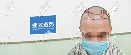 男性斑秃了应该怎么办 男性斑秃了应该怎么办