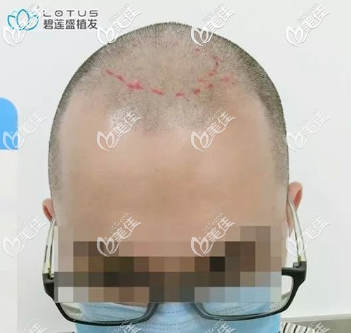 小程头顶出现一块斑秃 小程头顶出现一块斑秃