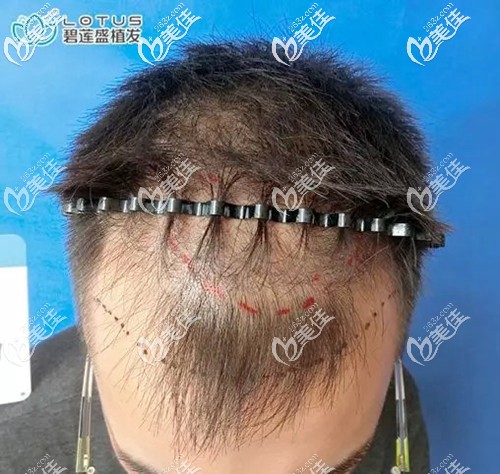 术前设计手术方案,决定做植发 术前设计手术方案,决定做植发