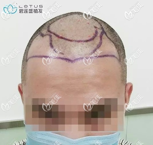 准备开始前额发际线种植 准备开始前额发际线种植