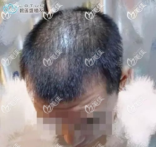 术后三个月的种植效果图 术后三个月的种植效果图