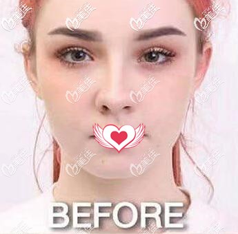 在泰国做假体垫下巴术前照片 在泰国做假体垫下巴术前照片