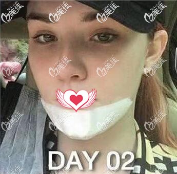 在泰国艺术整形外科做假体垫下巴术后第2天 在泰国艺术整形外科做假体垫下巴术后第2天