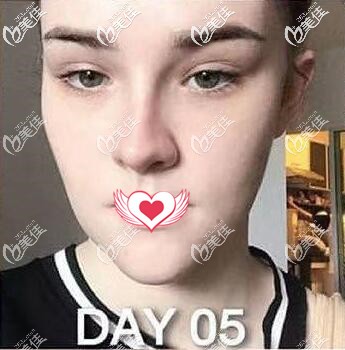 硅胶假体垫下巴术后第5天恢复效果 硅胶假体垫下巴术后第5天恢复效果