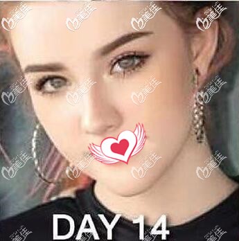 在泰国做假体垫下巴术后14天恢复效果图 在泰国做假体垫下巴术后14天恢复效果图