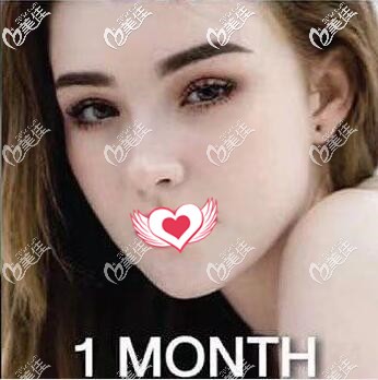 讲真的我在泰国艺术整形外科做假体垫下巴不仅价格便宜而且效果也很不错，很自然！