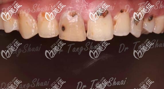 还纠结门牙龋齿能做瓷贴面吗我在北京朝阳区做的超薄全瓷牙齿贴面图片
