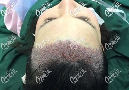 刚种植出来的美人尖并不是很美丽