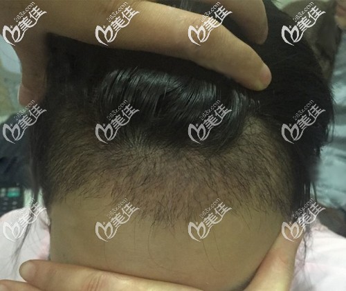 头发都长到1厘米了，竟然进入置换期开始掉了