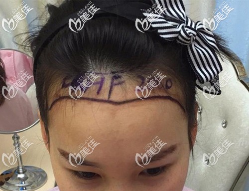 医生设计的发际线种植方案